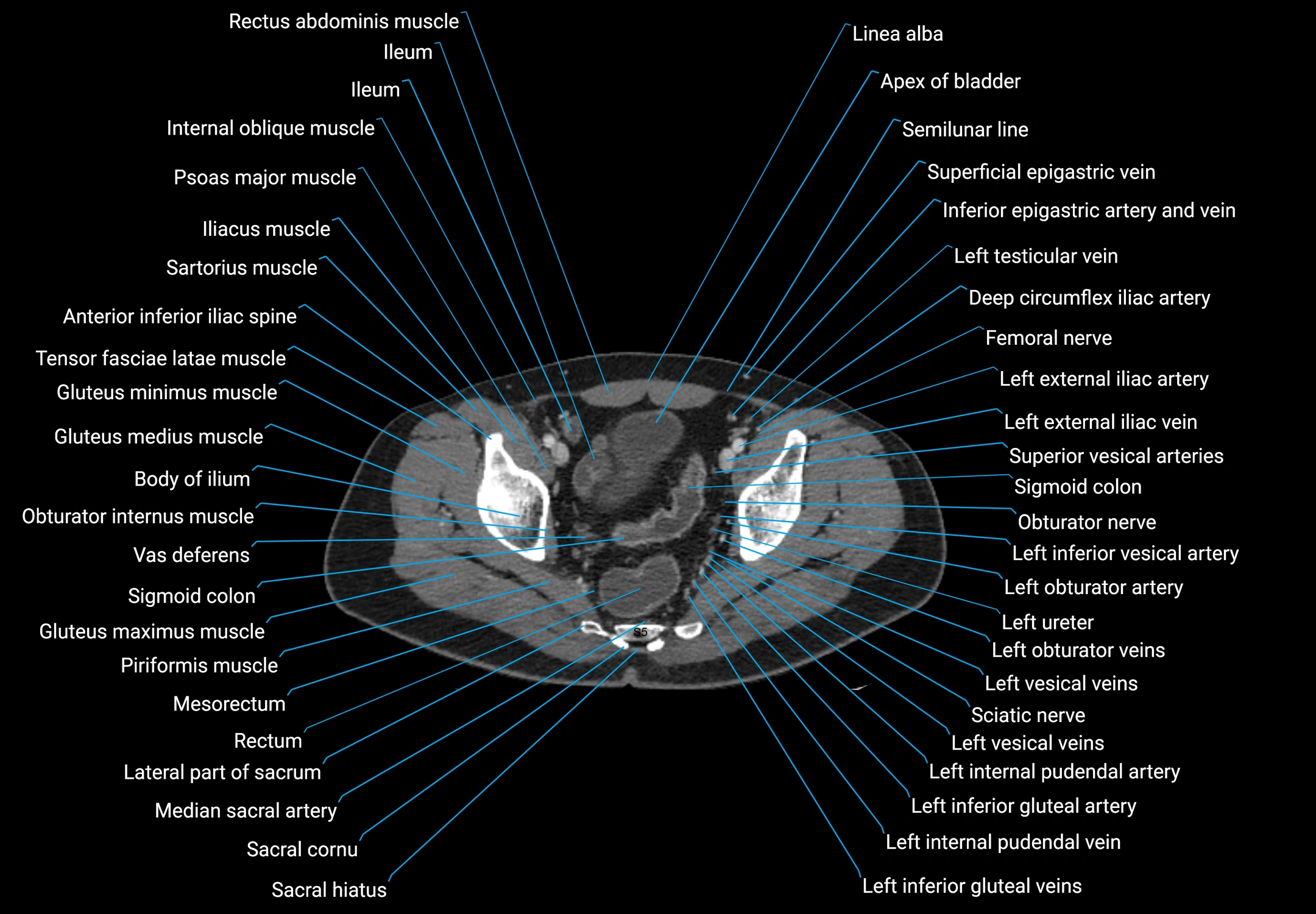 CT male pelvis axial cross sectional anatomy labelled radiology image -00174.webp